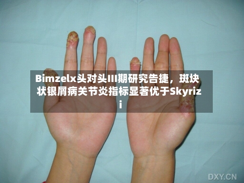 Bimzelx头对头III期研究告捷,斑块状银屑病关节炎指标显著优于Skyrizi
